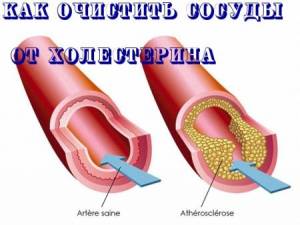 Как очистить сосуды от холестерина  (2012/WebRip) видеоурок